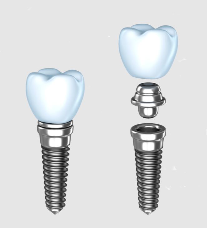 Neodent dantu implantai